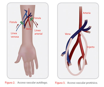 fistula-arterio-2