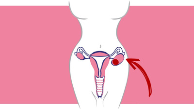 utero-ovario-4