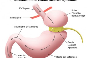 Banda gástrica y Operación Quirúrgica