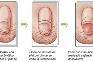 Circuncisión