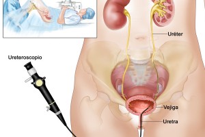 Extracción endoscópica de cálculos