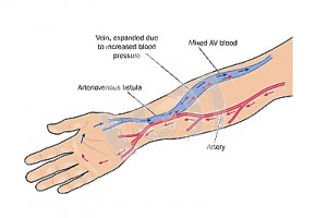 Fístula arterio-venosa