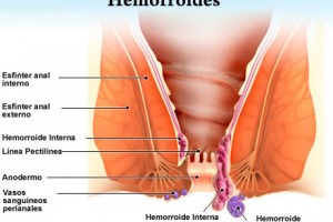 Hemorroides