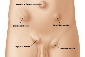 Cirugía Laparoscópica de hernias: inguinales, insicionales, umbilicales, etc.