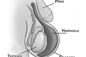 Hidrocele