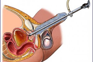 Resección de próstata por técnica moderna