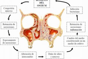 Cirugía endoscópica de senos paranasales