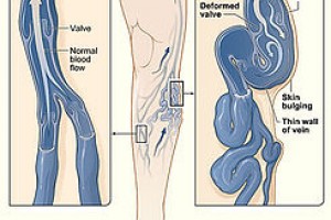 Tratamiento de insuficiencia venosa de los miembros inferiores