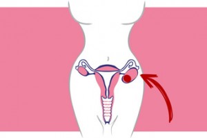 Cirugía laparoscópica de útero y ovario