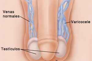 Varicoscele