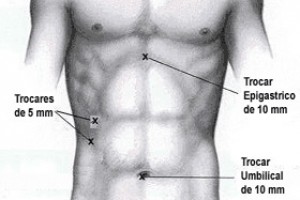 Cirugía Laparoscópica: vesícula (colecistectomia) y vías biliares