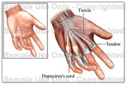 Cirugía de mano